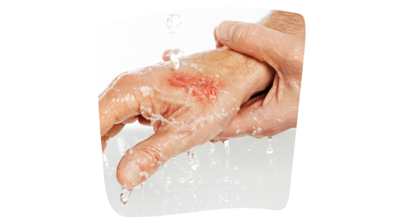 Mano con bajo el agua para lavar una herida antes de desinfectarla Mano con bajo el agua para lavar una herida antes de desinfectarla